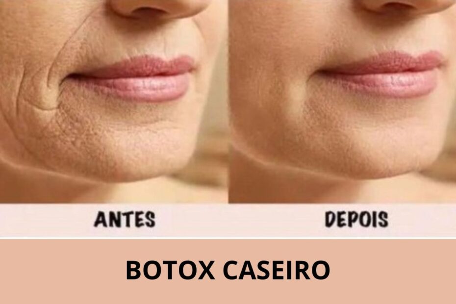 Botox Caseiro